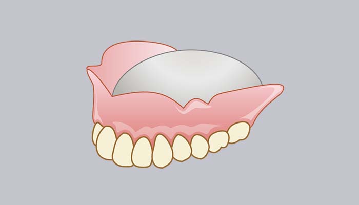 金属床義歯