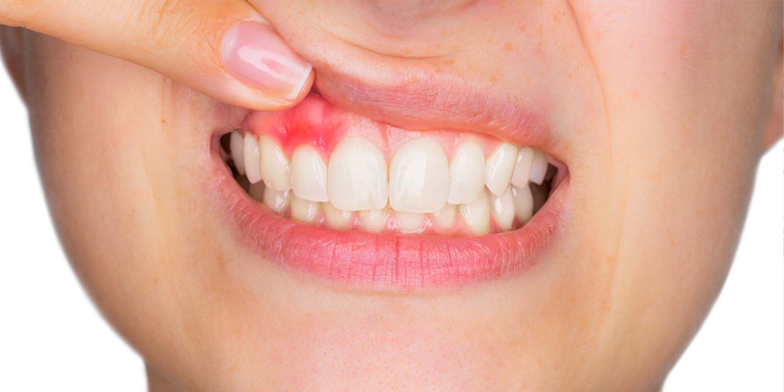 歯周病と歯槽膿漏・歯肉炎